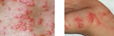 Image result for scabies in the groin area