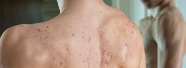 Como Eliminar El Acne De La Espalda Canalsalud
