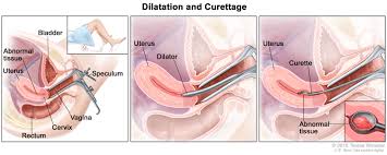 Unusual vaginal bleeding, spotting, or other discharge Endometrial Cancer Treatment Pdq Patient Version National Cancer Institute