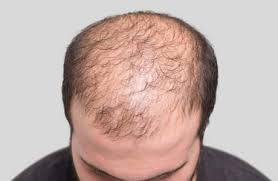 Alopecia is the medical term for hair loss, and it doesn't only happen on the scalp. Hair Loss Treatment Pakistan Baldness Treatment Hair Fall Solution
