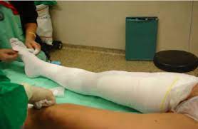 Graduated Compression Stockings Placed At The End Of The Procedure Download Scientific Diagram