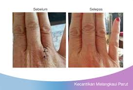 Ada ke cara hilangkan parut hitam di muka? Parut Saya Semakin Pudar Kulit Lebih Cantik Terima Kasih