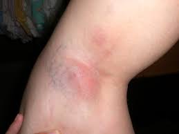 Health Blood Clots