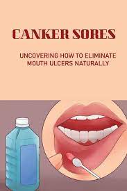 Canker Sores : Uncovering How To Eliminate Mouth Ulcers Naturally: How To Cure  Mouth Ulcers Fast Naturally (Paperback) - Walmart.com