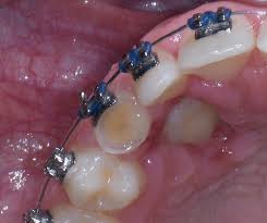 The mean surgical time table 3 for open eruption technique was 22.31 ± 1.98 min as compared to 30.87 ± 2.38 min to closed eruption technique. Early Intervention Of Palatally Impacted Canines Oral Health Group