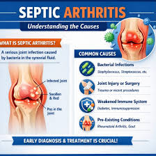 Image result for Septic Joint