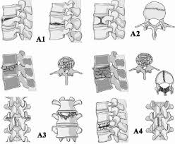 The Subtypes Of Compression Injures A0 Spinous Transverse Process Download Scientific Diagram
