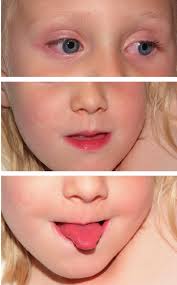 a) non-purulent conjunctivitis, b) strawberry red tongue, and c)...
