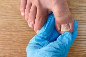 Image result for Paronychia feet