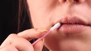 Herpes an den lippen kennt fast jeder: Lippenherpes Ursachen Symptome Und Behandlung Der Infektion