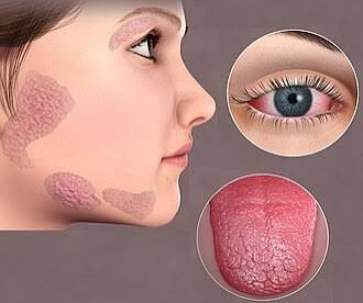 Hội chứng Sjögren – Wikipedia tiếng Việt