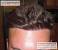 Best Hair Transplant Results In India