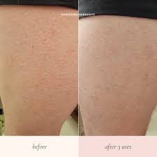 Image result for Keratosis pilaris