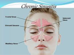 Image result for sinusitis