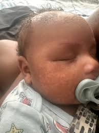 What could be causing my newborn baby's skin rash