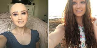 Here S Why This Fitness Blogger Revealed Her Alopecia On Instagram After 7 Years Short Hair Styles Long Hair Styles Long Hair Girl