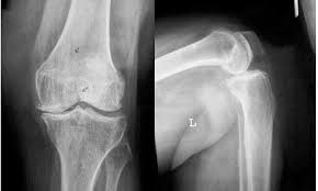 Of orthopaedic surgery bangalore baptist hospital. Radiograph Showing Stress Fracture Of Medial Femoral Condyle With Download Scientific Diagram