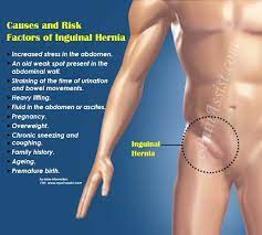 Doctor couldn't find any signs of a hernia or anything serious, said it seems like i irritated some muscle in the area. What Is Inguinal Hernia Inguinal Almost All Groin Hernias Are This Kind You Get Them When Part Of Your Intestine Pushes Through A Weakness In The Lower Belly And Affects An Area