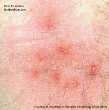 Mite Bites