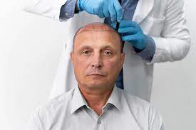 Recommendations After a Hair Transplant | Capilclinic ✔️