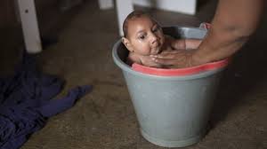 Como Se Encuentra Jose Wesley El Bebe Con Microcefalia Que Hace Un Ano Se Convirtio En La Cara Del A Emergencia Global Por El Zika Bbc News Mundo