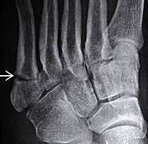 Well find out exactly how to get this bone feeling better! Jones Fracture Lisfranc Fracure Best Podiatrist Los Angeles University Foot And Ankle Institute