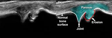 Image result for XRay Changes in Rheumatic Conditions