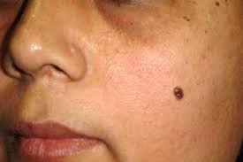 Mole Meanings On Body Face Male Female Lucky Or Unlucky mole meanings on body face male