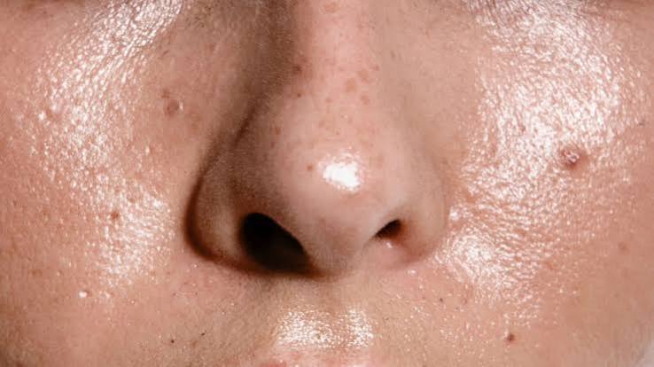 Oiliness & large pores