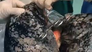 Pertanto, prima di iniziare a fumare, puoi scattare una foto dei tuoi polmoni per la memoria. Cina Chirurgo Mostra I Polmoni Di Un Fumatore Il Video Virale Scienze Notizie
