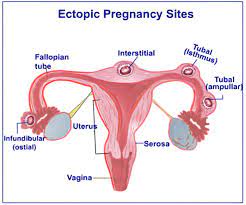 The diagnosis of ectopic pregnancy may sometimes be difficult, and symptoms may occur from as early as 4 weeks. Ectopic Pregnancy Causes Symptoms Diagnosis Treatment Faqs