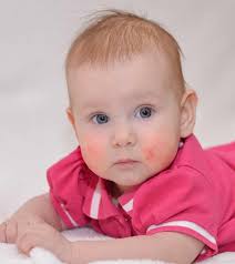 Dogs have different digestive systems than humans, which means some people food that se. Food Allergies In Babies Causes Symptoms And Treatment
