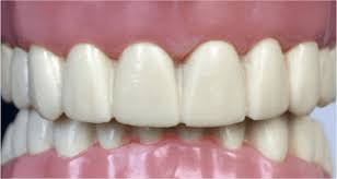 Maybe you would like to learn more about one of these? What Is An Overbite Deep Overbite Treatment For Adults