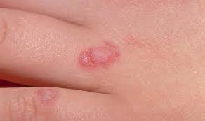 Here are 10 more facts about prostate cancer. Skin Cancer Symptoms Easily Missed Signs Of The Deadly Condition Express Co Uk