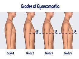 Gynecomastia Alert Dos And Donts Before Male Breast