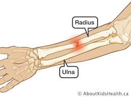 Image result for Forearm Fracture