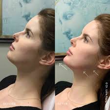 Jawline + chin contouring with fillers! We used two syringes of Radiesse to  achieve this result and balance out her profile. ➡️ Swipe for more photos!  @ San Francisco, California