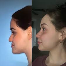 4 weeks post Double Jaw Surgery : r/PlasticSurgery