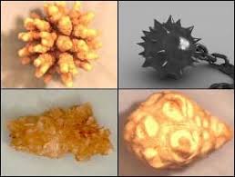 Kidney Stones Are Usually Made Out Of Calcium Oxalate But Could Also Be Calcium Phosphate Cystine Barbed Wire Or Mol Calcium Phosphate Kidney Stones Kidney