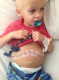 We are so heartbroken & saddened that the Dr (Dr Blake Palmer) who  performed McKoy's kidney/tumor resection surgery in 2014, has passed away.  He was an incredibly talented pediatric urologist. Blake was