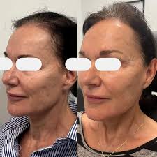 NEOGEN PSR ] ➡️Neogen before & after : ➕this lovely client had a Neogen  treatment 9 months ago ➕Neogen benefits will start around 6 months and  continue for up to 2