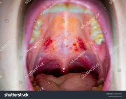 Image result for Canker sores symptoms roof of the mouth