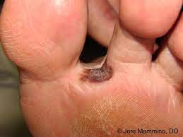 If a nodule doesn't form, the cancer may develop more like a reddish, scaly patch. Melanoma American Osteopathic College Of Dermatology Aocd