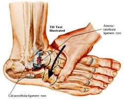 9 injury to the atfl typically is followed by injury to the calcaneofibular ligament (cfl) and the posterior talofibular ligament. Ankle Sprains Orland Park Orthopedics