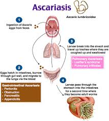 Ascariasis Ciri Ciri Gejala Dan Pengobatan Apa Itu Penyakit Ascariasis Apakah Anda Mengalaminya Dan Bagaimana Cara Pengob Kedokteran Kesehatan Penyakit