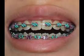 Pin By Hannah Parks On Braces Life Braces Colors Dental Braces Getting Braces