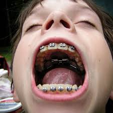 This is because orthodontic treatment is highly personalized based on both the orthodontist and the patient. The History Of Braces An Object Lesson The Atlantic