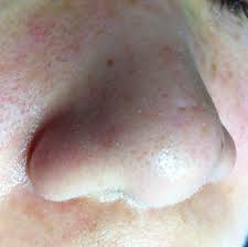 ふやけていますねー 皮脂分泌が増える夏場は エクストラケアで角栓を撃退 角栓 皮脂 ローション