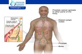 A cancer diagnosis can leave you unable to comprehend anything else your doctor says, but it's important to pay attention to what stage of cancer you have. Prostate Cancer Stage 4 Symptoms Treatment Iranian Surgery