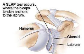 The subacromial bursa lies on the top portion of the supraspinatus tendon. Shoulder Labral Tear Relevant Anatomy And Function Ashvin K Dewan Md Orthopedic Surgeon